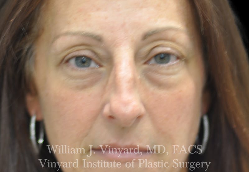 Eyelid Lift Before & After Gallery - Patient 535873 - Image 1