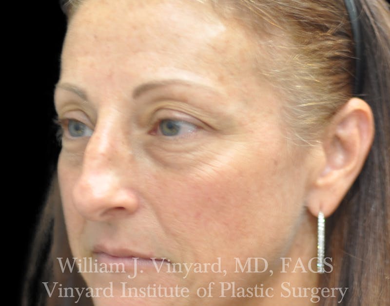 Eyelid Lift Before & After Gallery - Patient 535873 - Image 3