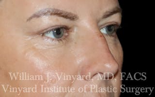 Eyelid Lift Before & After Gallery - Patient 631601 - Image 4