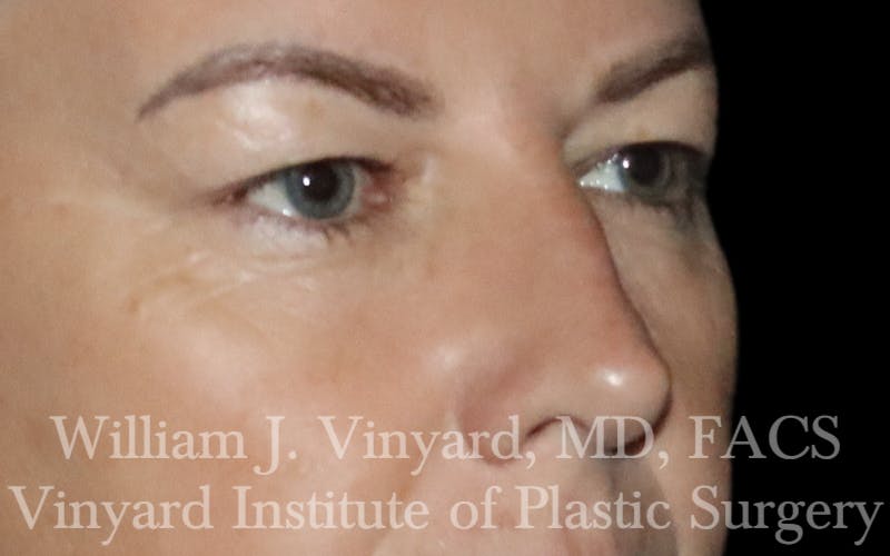 Eyelid Lift Before & After Gallery - Patient 631601 - Image 3