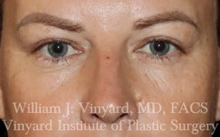 Eyelid Lift Before & After Gallery - Patient 631601 - Image 2