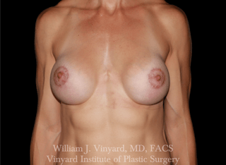 Breast Augmentation Before & After Gallery - Patient 258410 - Image 2