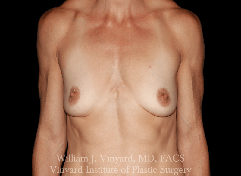 Breast Augmentation Before & After Gallery - Patient 258410 - Image 1