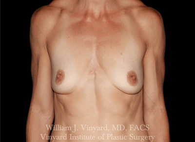 Breast Augmentation Before & After Gallery - Patient 258410 - Image 1
