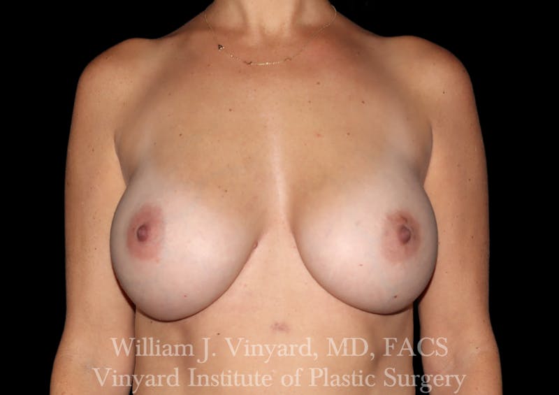 Breast Augmentation Before & After Gallery - Patient 920305 - Image 2