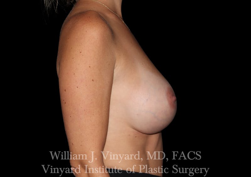 Breast Augmentation Before & After Gallery - Patient 920305 - Image 8