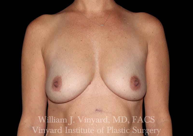 Breast Augmentation Before & After Gallery - Patient 920305 - Image 1