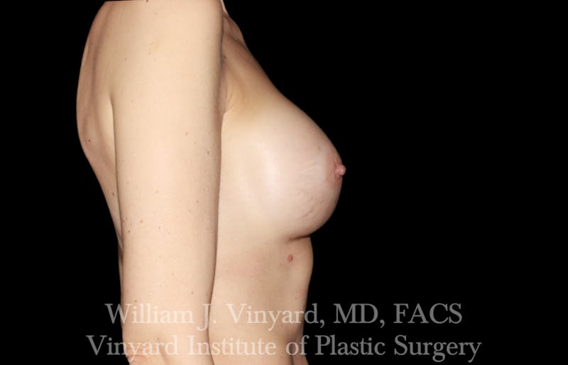Breast Augmentation Before & After Gallery - Patient 101345 - Image 8