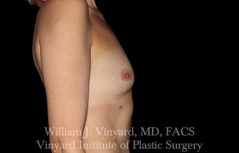 Breast Augmentation Before & After Gallery - Patient 101345 - Image 7