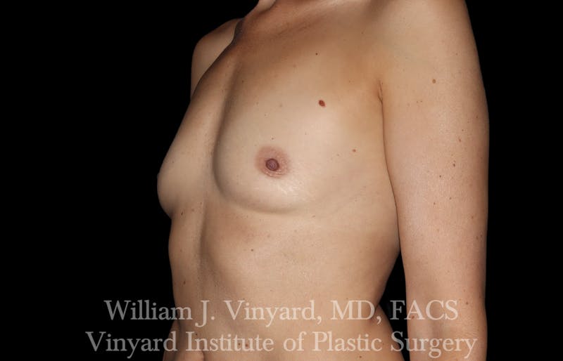 Breast Augmentation Before & After Gallery - Patient 101345 - Image 10