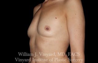 Breast Augmentation Before & After Gallery - Patient 101345 - Image 10