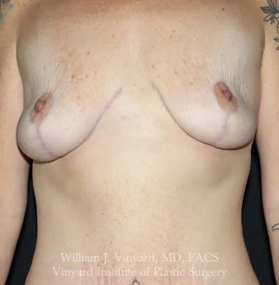 Breast Lift Before & After Gallery - Patient 348469 - Image 2