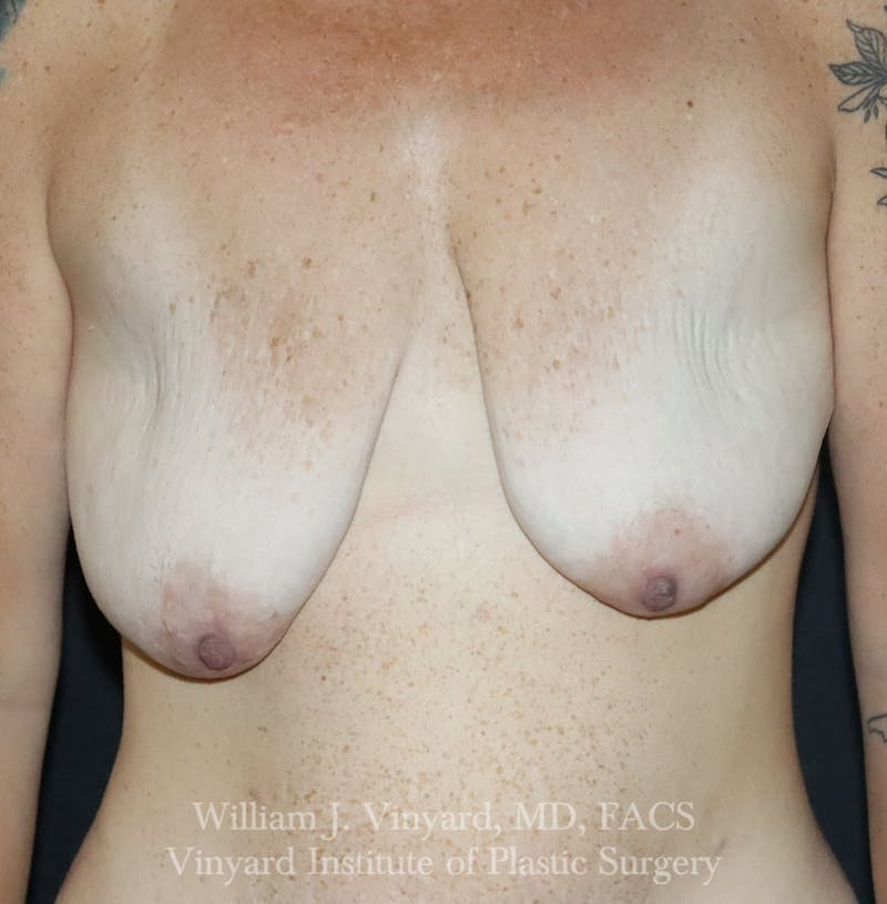 Breast Lift Before & After Gallery - Patient 348469 - Image 1