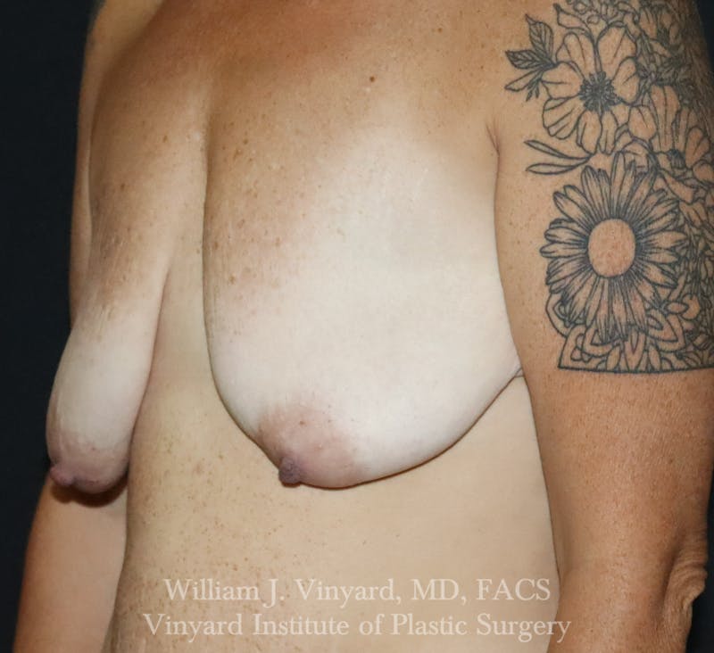 Breast Lift Before & After Gallery - Patient 348469 - Image 5