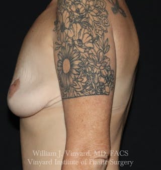 Breast Lift Before & After Gallery - Patient 348469 - Image 8