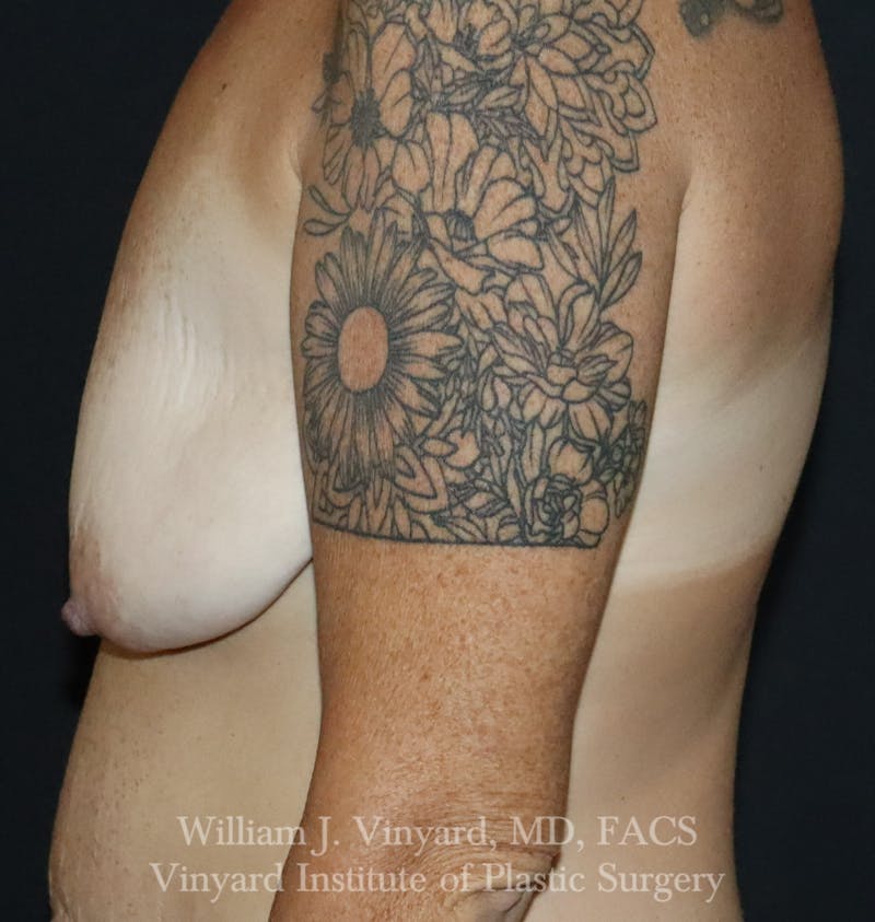 Breast Lift Before & After Gallery - Patient 348469 - Image 7