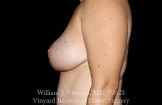 Breast Lift Before & After Gallery - Patient 184820 - Image 4
