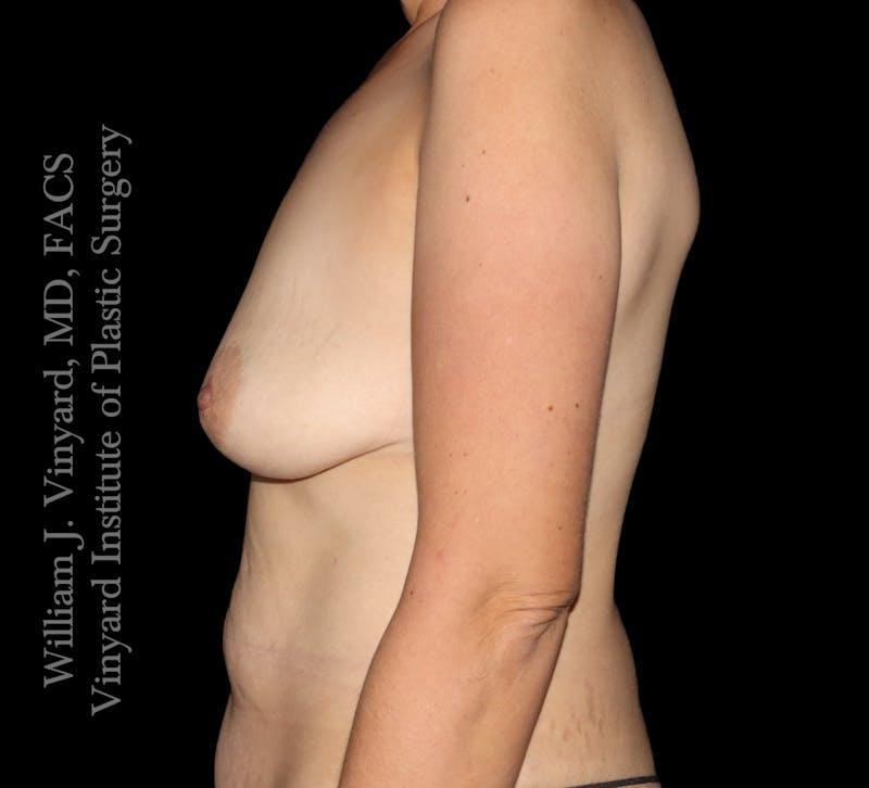 Breast Lift + Augmentation Before & After Gallery - Patient 364401 - Image 5