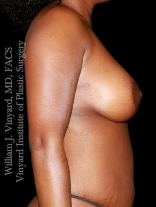 Breast Lift + Augmentation Before & After Gallery - Patient 157466 - Image 6