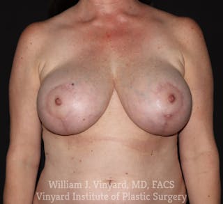 Breast Implant Exchange Before & After Gallery - Patient 200259 - Image 2
