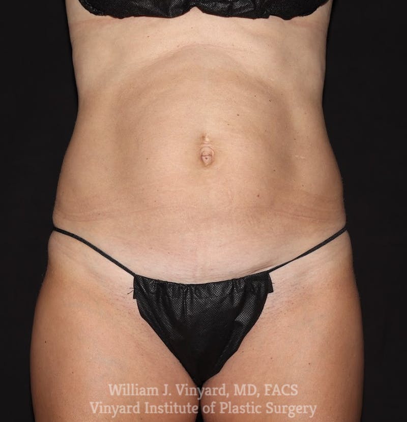 Tummy Tuck Before & After Gallery - Patient 192540 - Image 1
