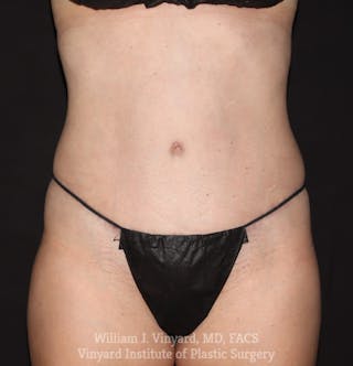Tummy Tuck Before & After Gallery - Patient 192540 - Image 2