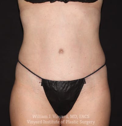 Tummy Tuck Before & After Gallery - Patient 192540 - Image 2