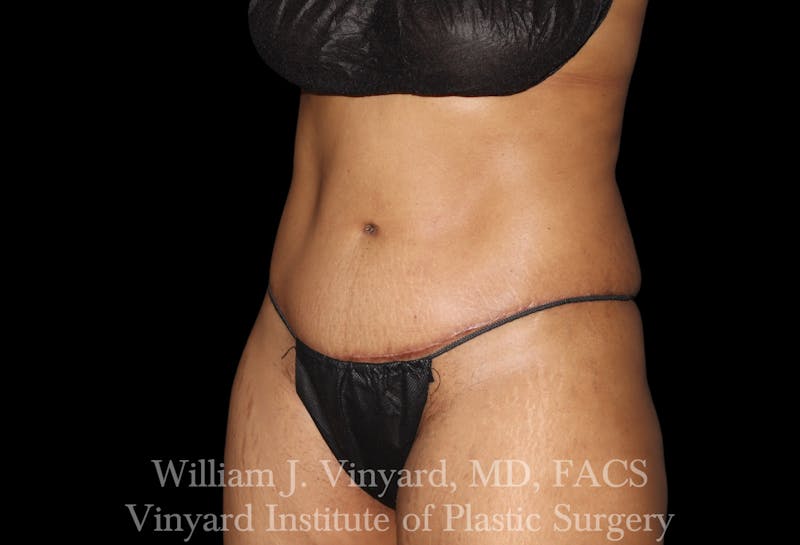 Tummy Tuck Before & After Gallery - Patient 421080 - Image 8