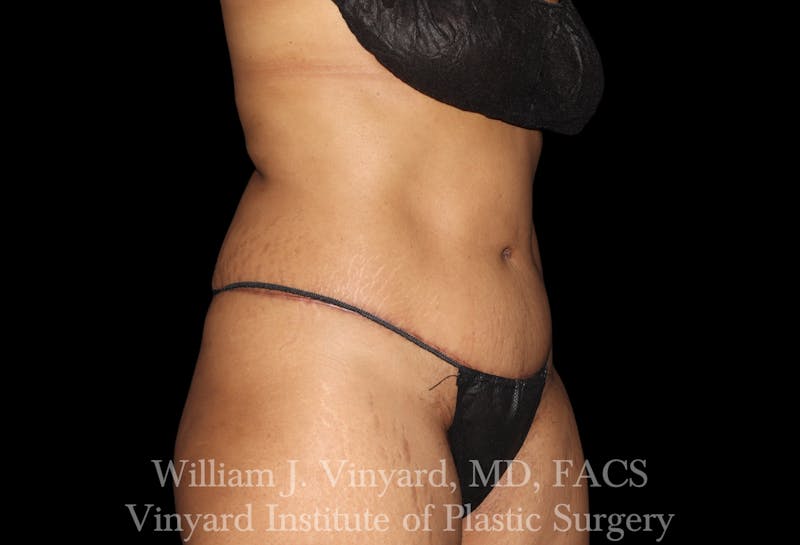Tummy Tuck Before & After Gallery - Patient 421080 - Image 4