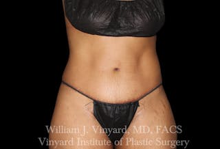 Tummy Tuck Before & After Gallery - Patient 421080 - Image 2