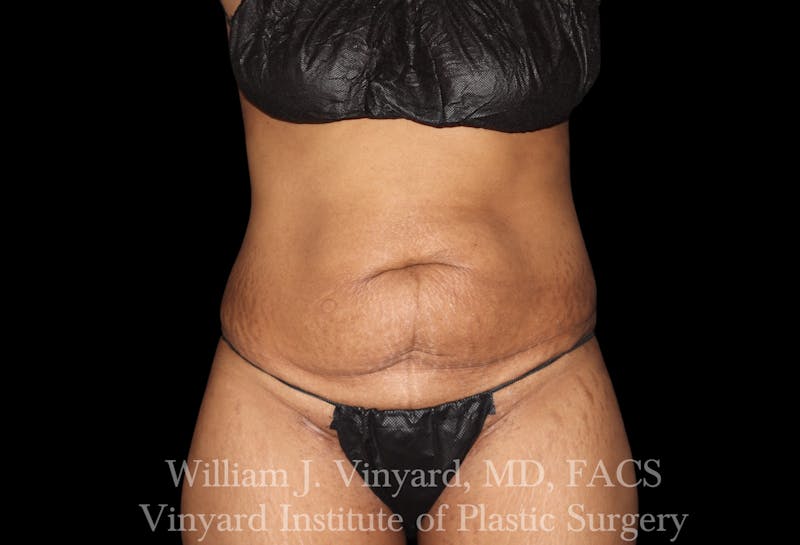 Tummy Tuck Before & After Gallery - Patient 421080 - Image 1