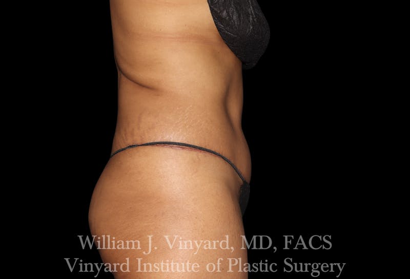Tummy Tuck Before & After Gallery - Patient 421080 - Image 6