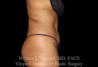 Tummy Tuck Before & After Gallery - Patient 421080 - Image 6