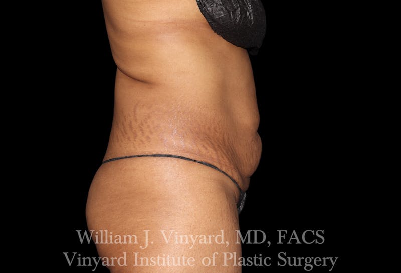 Tummy Tuck Before & After Gallery - Patient 421080 - Image 5