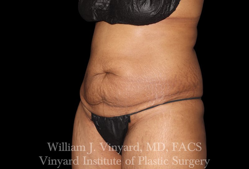 Tummy Tuck Before & After Gallery - Patient 421080 - Image 7