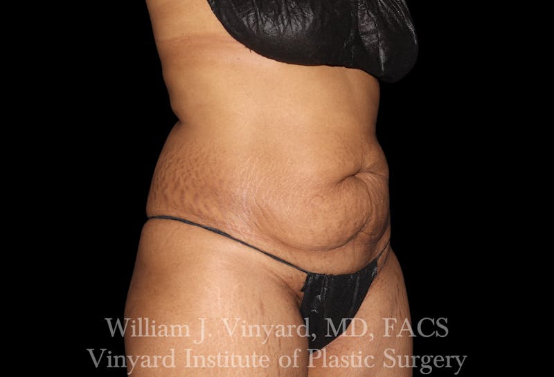 Tummy Tuck Before & After Gallery - Patient 421080 - Image 3