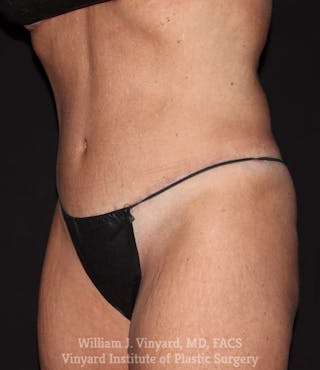 Tummy Tuck Before & After Gallery - Patient 169942800 - Image 6