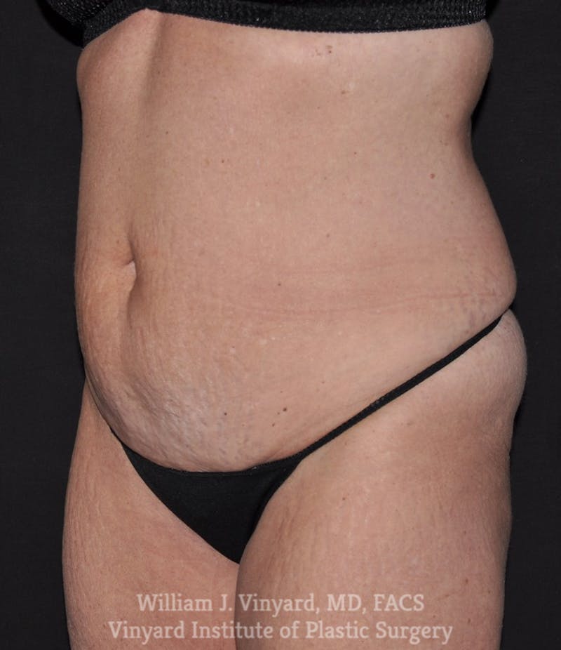 Tummy Tuck Before & After Gallery - Patient 169942800 - Image 5