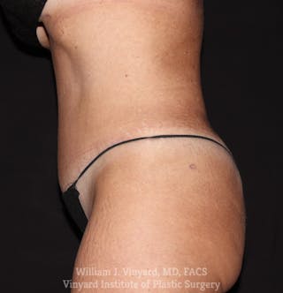 Tummy Tuck Before & After Gallery - Patient 169942800 - Image 4
