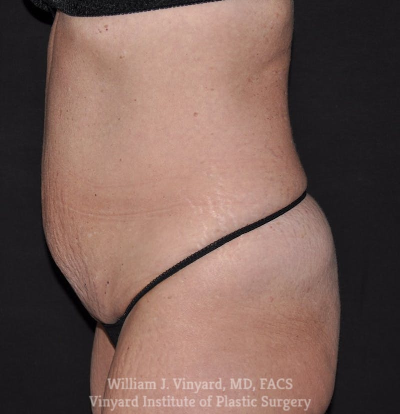 Tummy Tuck Before & After Gallery - Patient 169942800 - Image 3