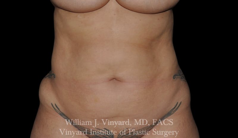 BODYTite / Liposuction Before & After Gallery - Patient 169755722 - Image 1