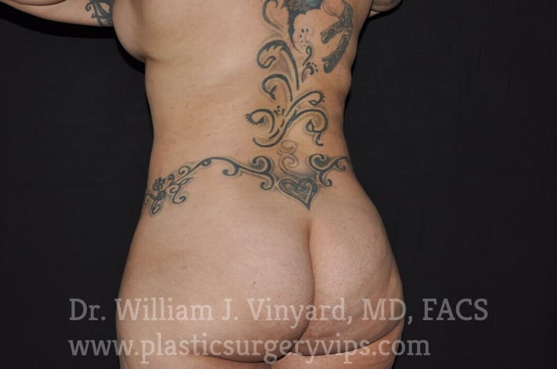 BODYTite / Liposuction Before & After Gallery - Patient 169755722 - Image 10
