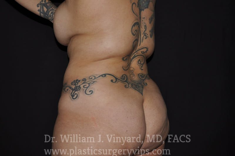 BODYTite / Liposuction Before & After Gallery - Patient 169755722 - Image 9