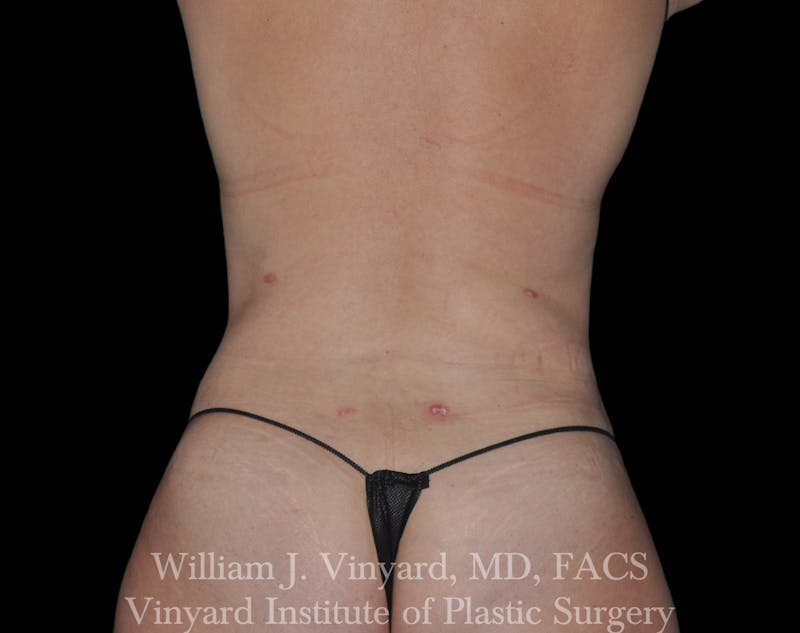 BODYTite / Liposuction Before & After Gallery - Patient 169755661 - Image 8