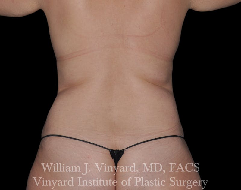 BODYTite / Liposuction Before & After Gallery - Patient 169755661 - Image 7