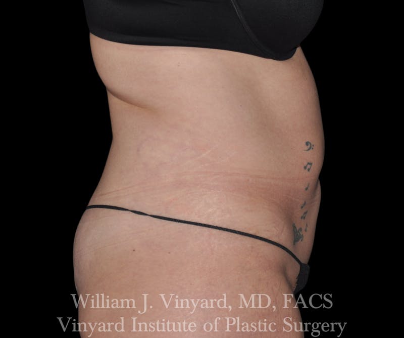 BODYTite / Liposuction Before & After Gallery - Patient 169755661 - Image 9