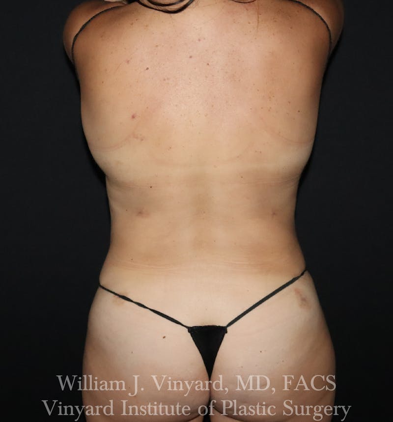 BODYTite / Liposuction Before & After Gallery - Patient 260646 - Image 2