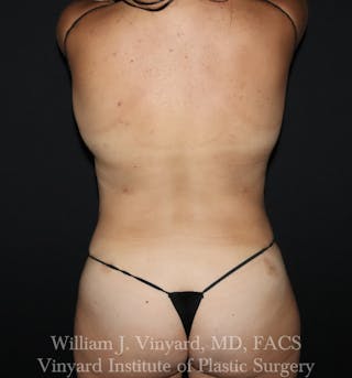 BODYTite / Liposuction Before & After Gallery - Patient 260646 - Image 2
