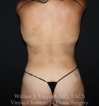 BODYTite / Liposuction Before & After Gallery - Patient 260646 - Image 2