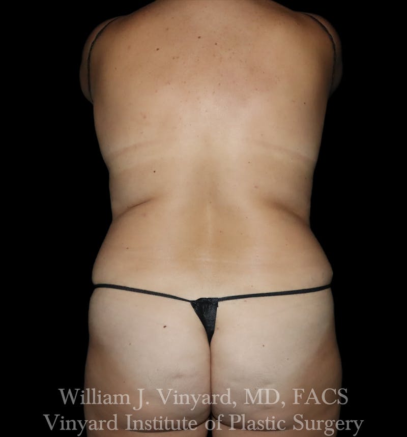 BODYTite / Liposuction Before & After Gallery - Patient 260646 - Image 1